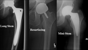 Hip Replacement Research